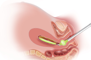 Diagram of the JADA® System Device Inserted Into Uterus to Induce Contractions